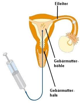 Schema der Intrauterinen Insemination