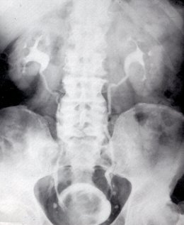 Urographie: Kontrastmitteluntersuchung der Niere; Röntgenbild