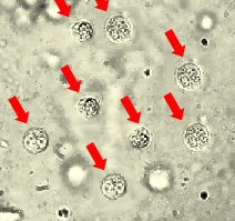 Weiße Blutkörperchen im Harn im Mikroskop betrachtet
