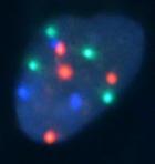 Normale Krebszelle der Blasenschleimhaut mit markierten Chromosomenabschnitten