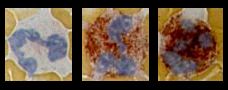 Unterschiedlich stark gefärbte Neutrophile Granulozyten
