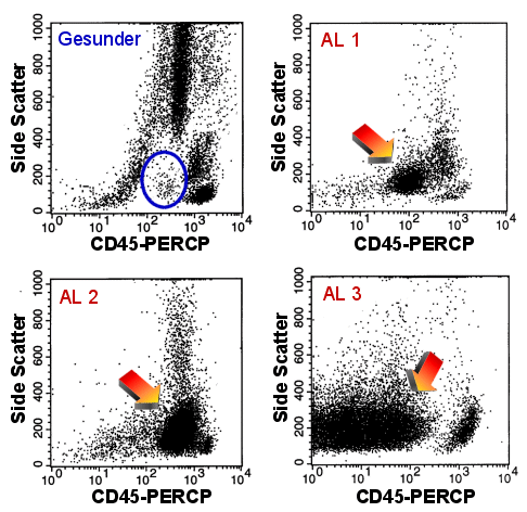 Die Darstellung von CD45-Expression und Side Scatter hilft CD34-negative Blasten zu erkennen.