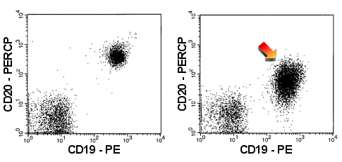 Die malignen B-Zellen (rechter Dot-Plot) zeigen eine schwache CD20-Expression