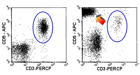CD3-Verlust bei extrem starker CD5-Expression (Pfeil rechter Dot-Plot) der malignen Zellen