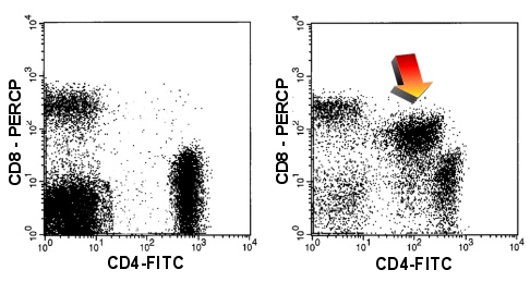 Die gleichzeitige Expression von CD4 und CD8 (rechter Dot-Plot) entlarvt die malignen Zellen