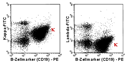Kappa-monoklonale B-Zellen nach Doppelfärbung CD19 und Leichtkette