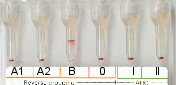 Serumgegenprobe (A1, A2, B und 0-Zellen) bei Blutgruppe A inkl. Antikrperscreening bei Raumtemperatur