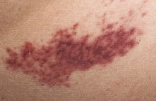 Gefäßentzündung (Vaskulitis) verursacht Blutungen - violette Flecken (Purpura) der Haut